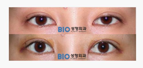 Personal information of Dr. Cho In-chang from Korea: Practices at Seoul BIO Peninsula Plastic Surgery, with a high-quality gallery of real cases demonstrating eye restoration procedures.插图3 Why so many customers specifically seek out Cho In-chang for eye restoration procedures?
