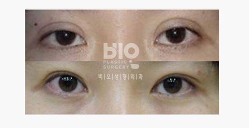 Personal information of Dr. Cho In-chang from Korea: Practices at Seoul BIO Peninsula Plastic Surgery, with a high-quality gallery of real cases demonstrating eye restoration procedures.插图2 Why so many customers specifically seek out Cho In-chang for eye restoration procedures?